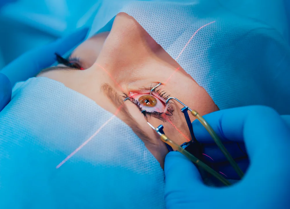 Cirurgia oftalmológica de correção da visão a laser em centro cirúrgico
